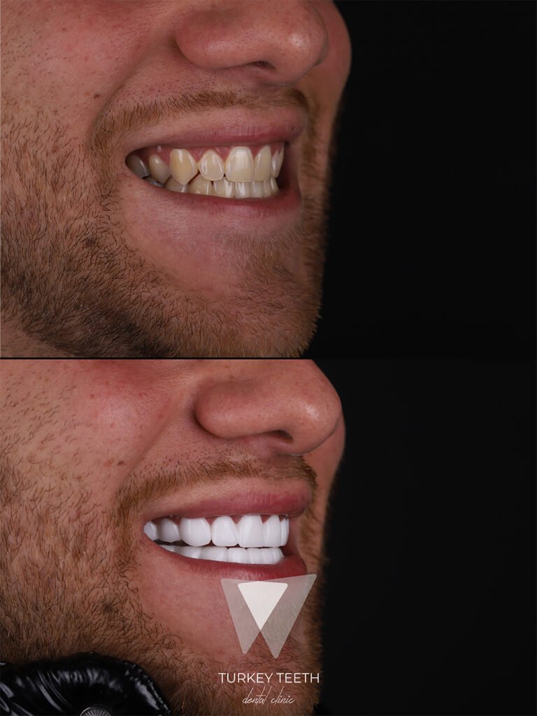 Zirconium Crowns in Turkey – Strong, natural-looking dental crowns by Turkey Teeth.