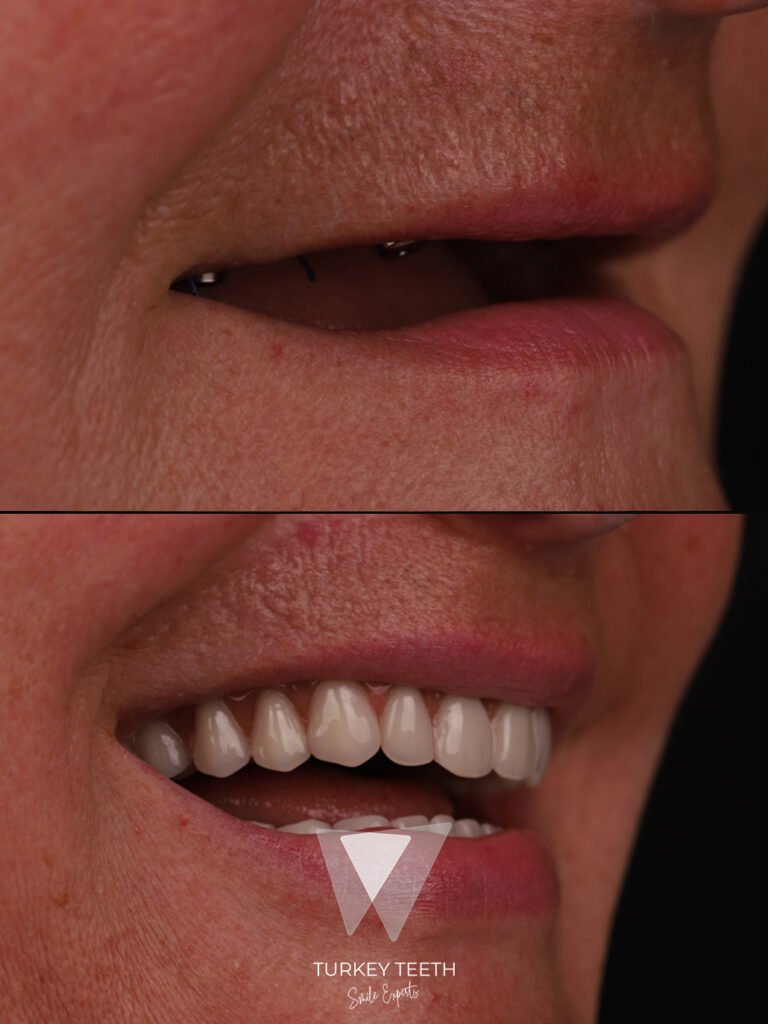Before and after full arch restoration with All-on-4 dental implants in Turkey