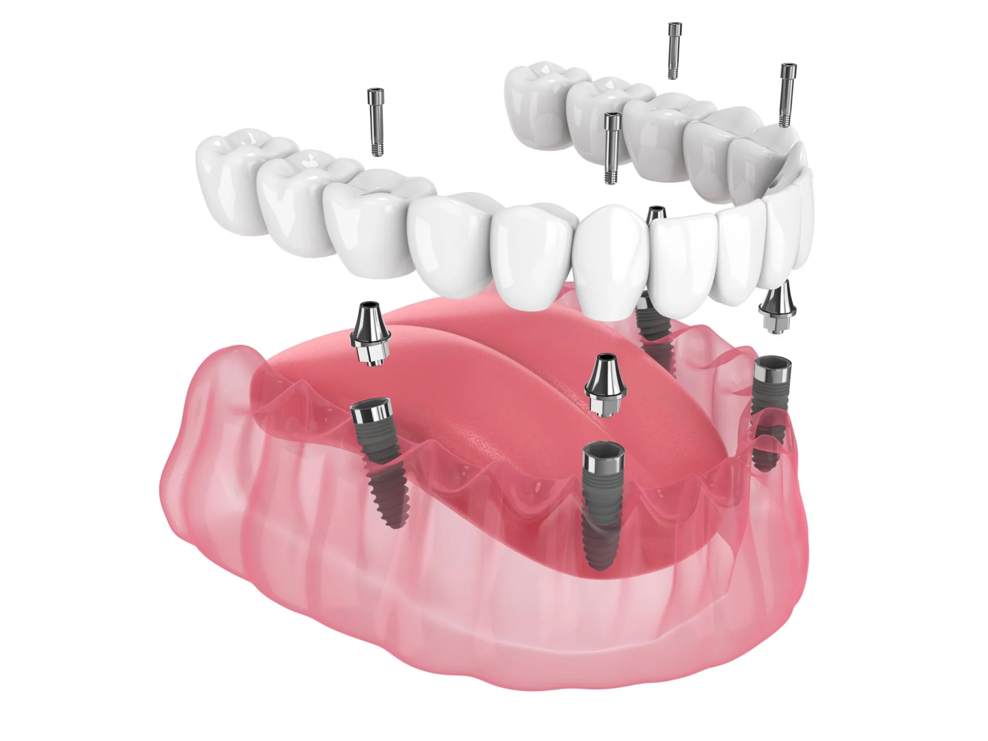 3D illustration of the All-on-4 dental implants system showing angled implants, abutments, and full-arch bridge