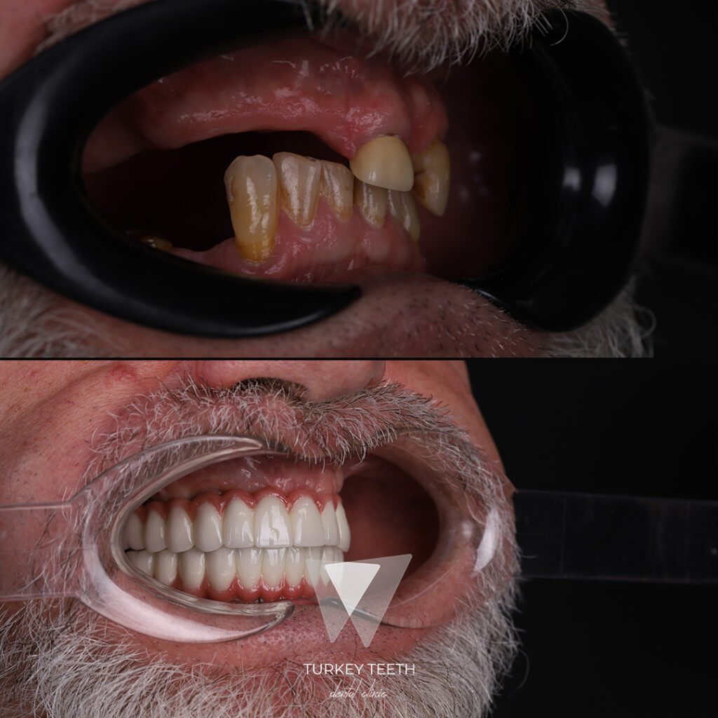 Before and after image of a full-mouth All-on-6 dental implant treatment showing complete oral rehabilitation
