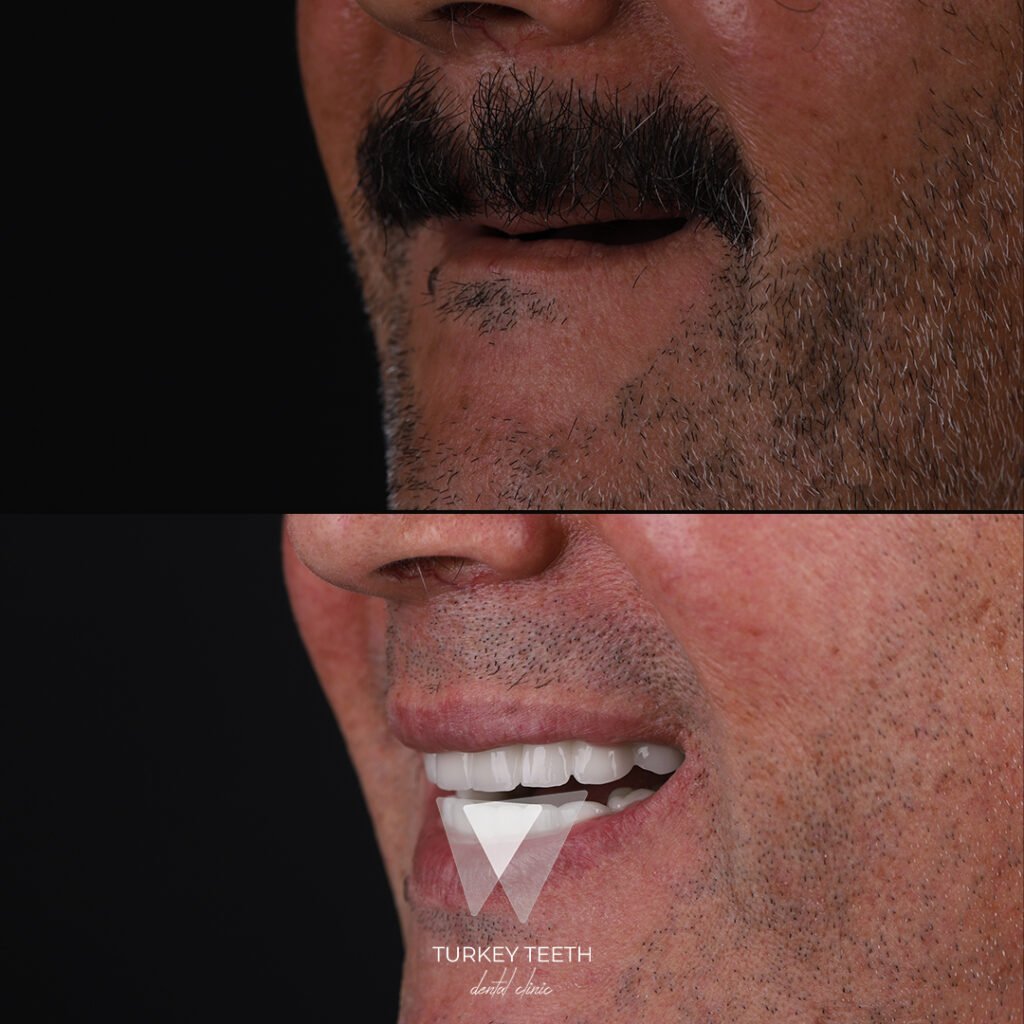 Side view before and after All-on-6 dental implants showing natural-looking full-arch restoration