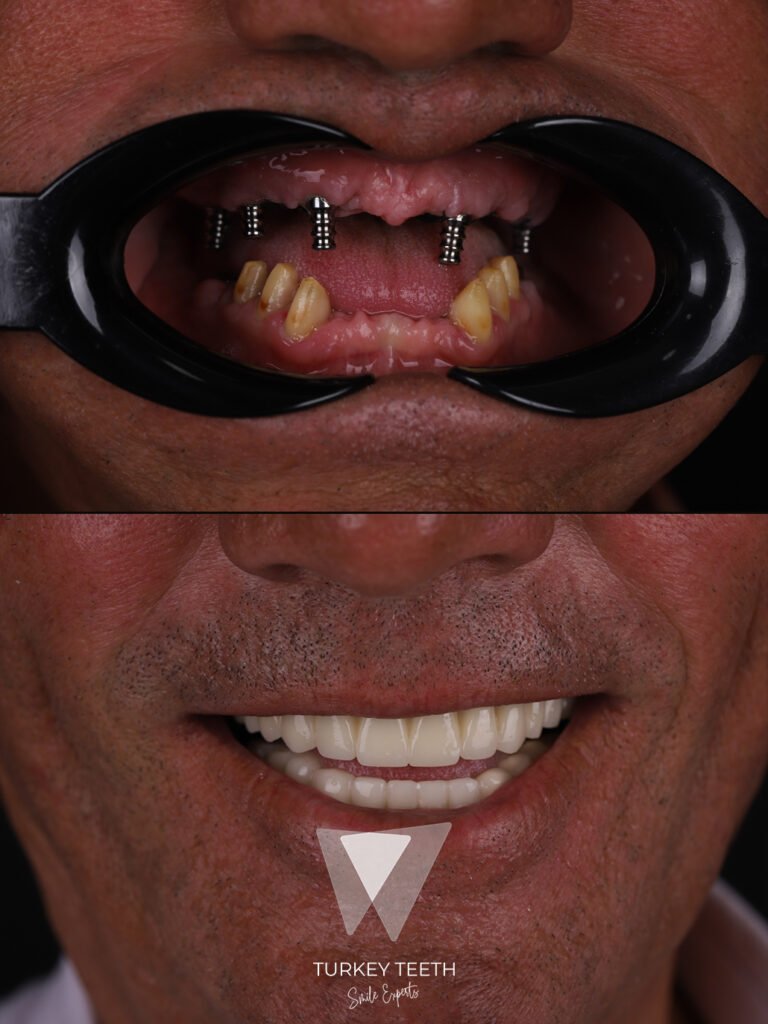 Before and after All-on-6 dental implants in Turkey showing a full arch fixed smile restoration