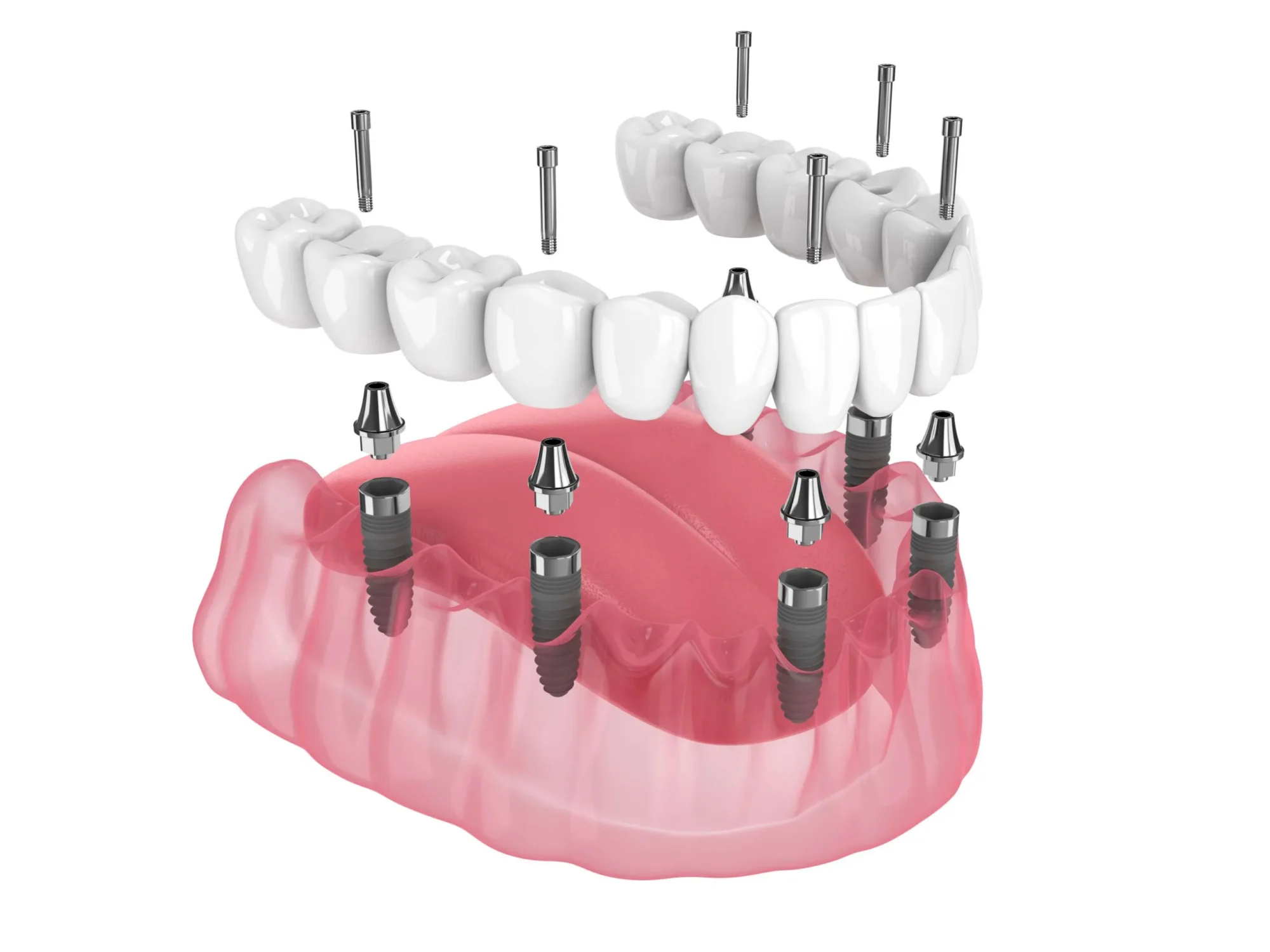 3D illustration of the All-on-6 dental implant system showing six implants, abutments, and a full-arch fixed bridge