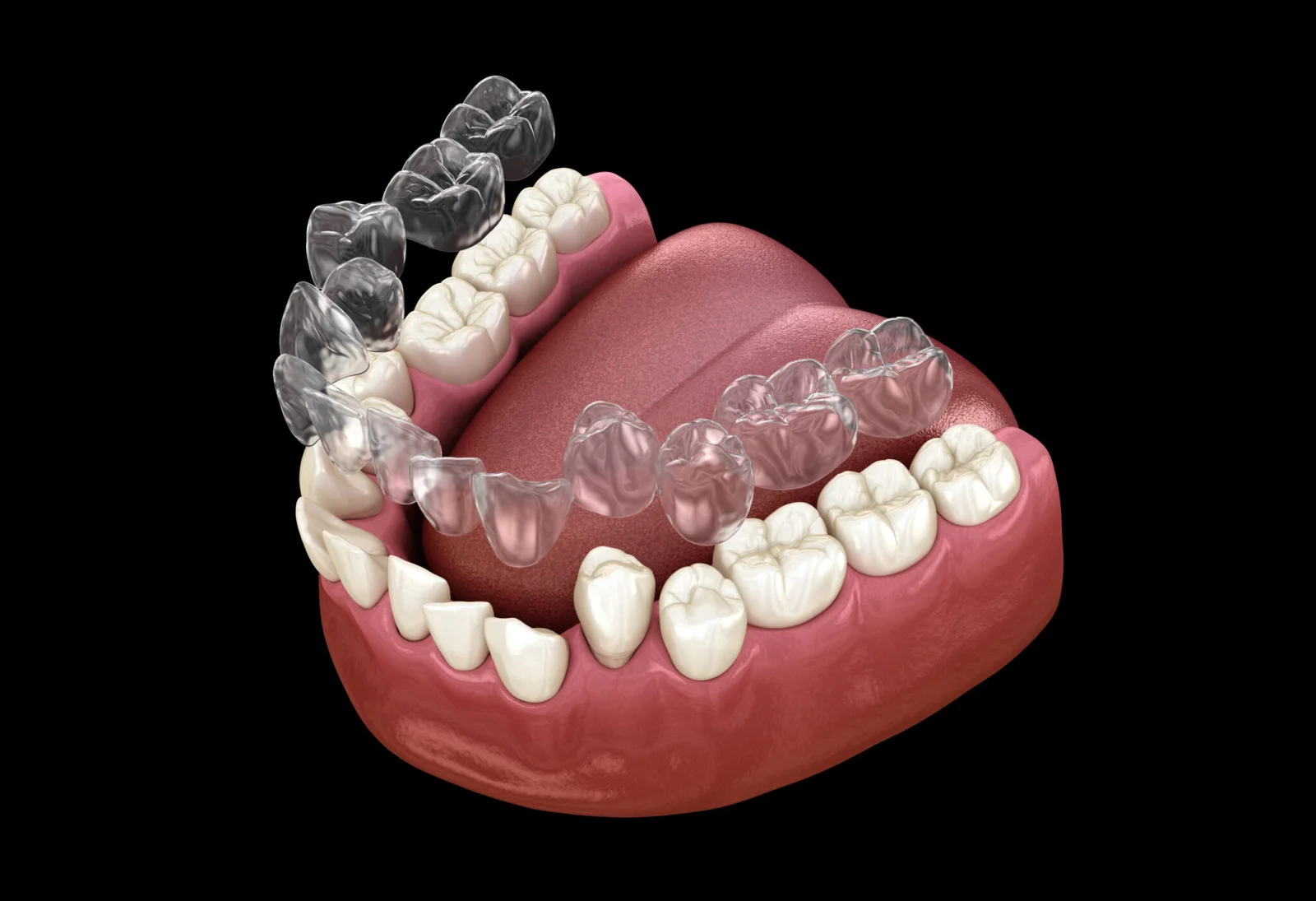 3D illustration of Invisalign aligners fitting on teeth - Invisalign Turkey