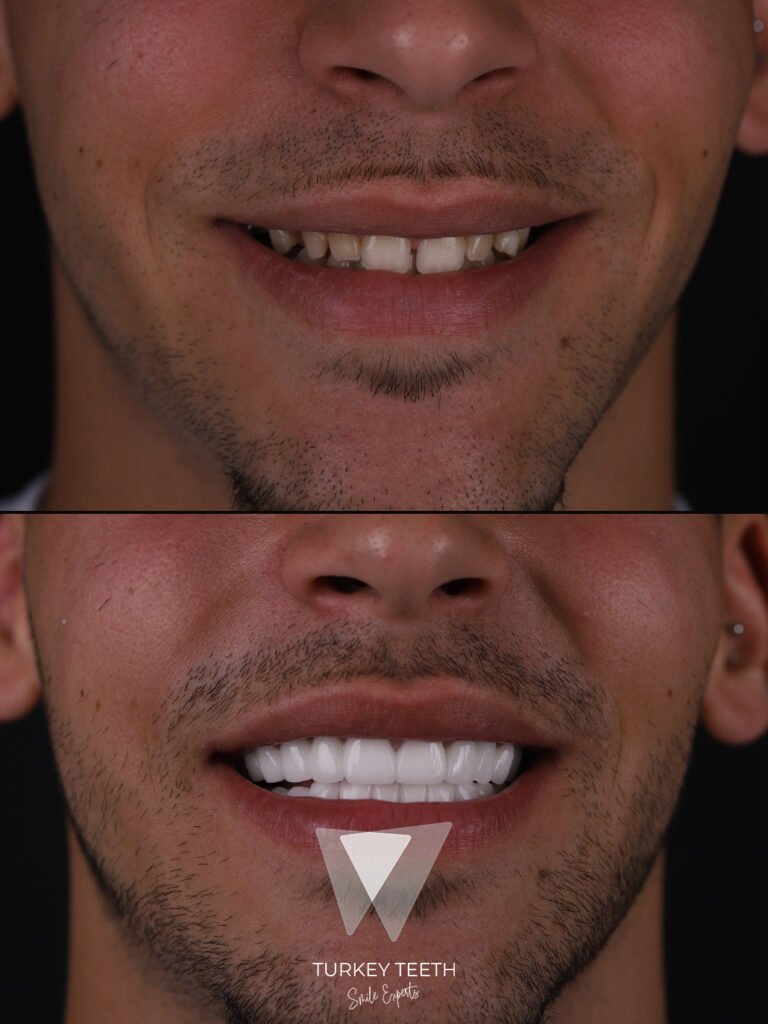 Close-up view of ultra-thin laminate veneers applied to natural teeth in Turkey