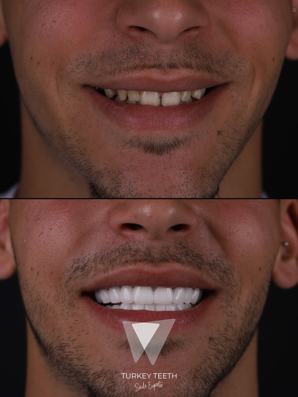Close-up view of ultra-thin laminate veneers applied to natural teeth in Turkey