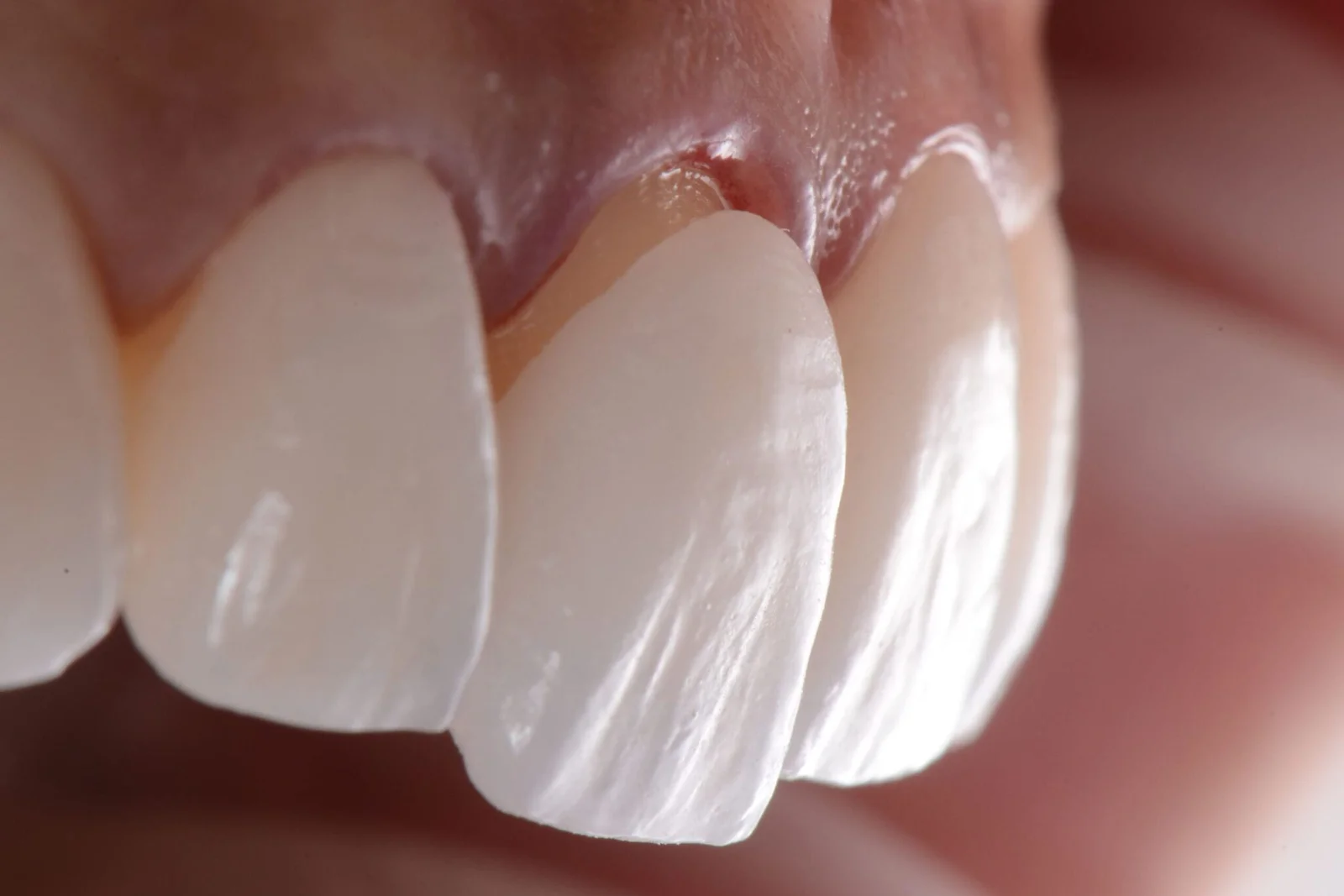 Close-up view of ultra-thin laminate veneers applied to natural teeth in Turkey