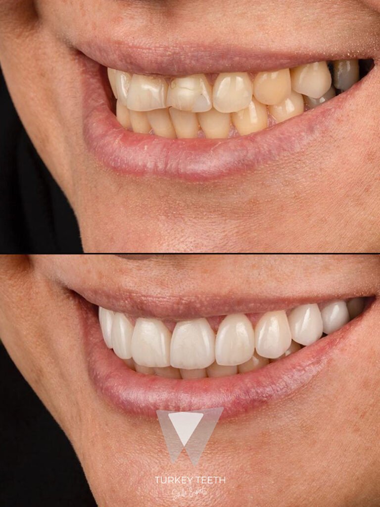 Before and after smile makeover in Turkey showing natural-looking front teeth transformation