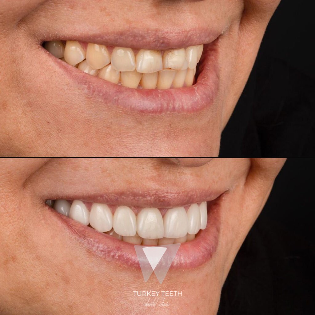 Before and after front view of smile makeover in Turkey showing natural white aesthetic improvement