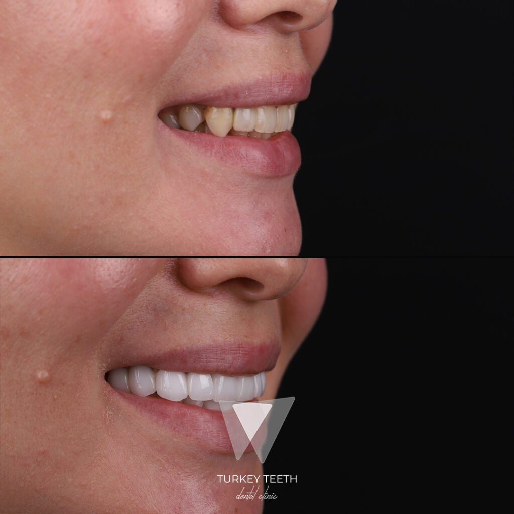 Before and after side view of smile makeover treatment in Turkey showing full upper arch transformation