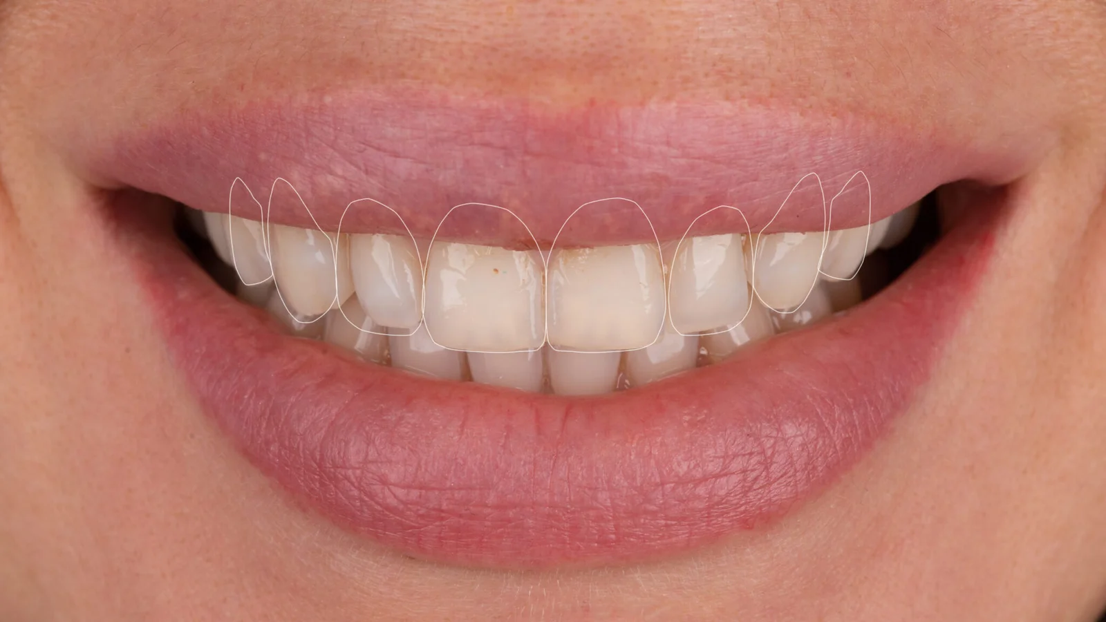 Digital smile design planning showing tooth shape and smile alignment for a smile makeover in Turkey