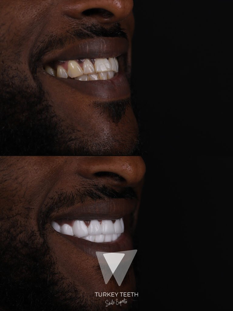 Teeth whitening before and after result at Turkey Teeth in Antalya.