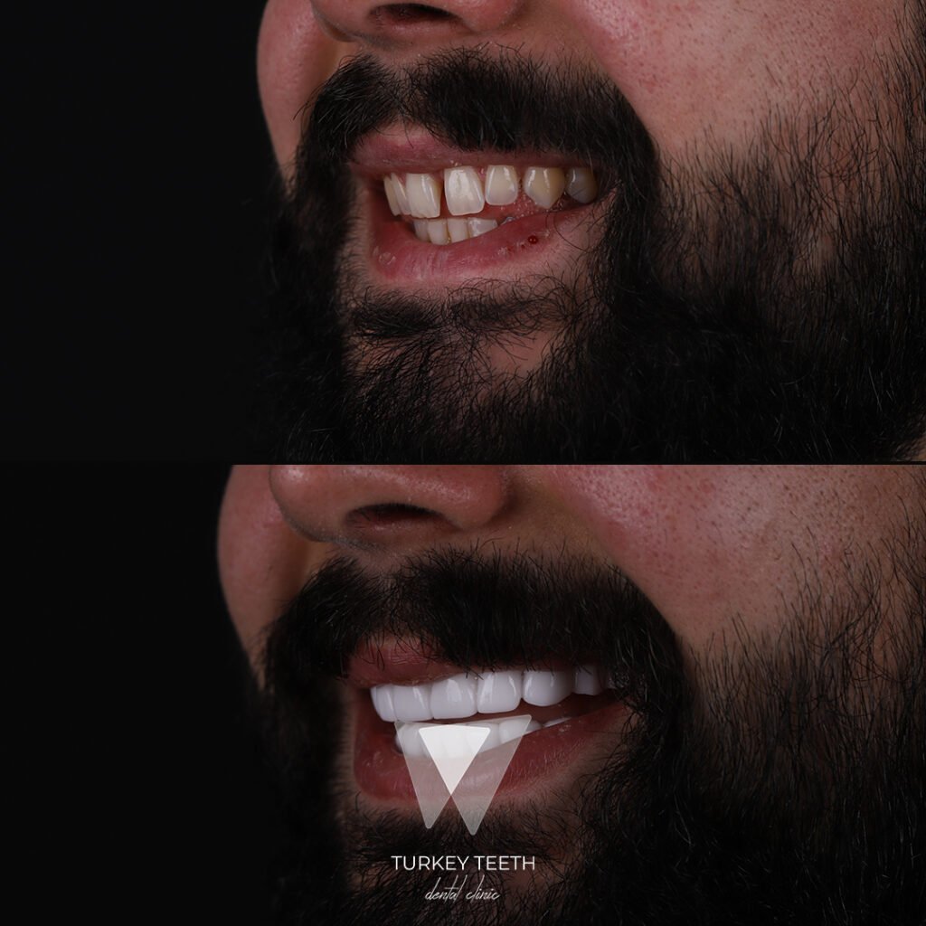 Before and after zirconium crowns in Turkey on a male patient showing full smile transformation