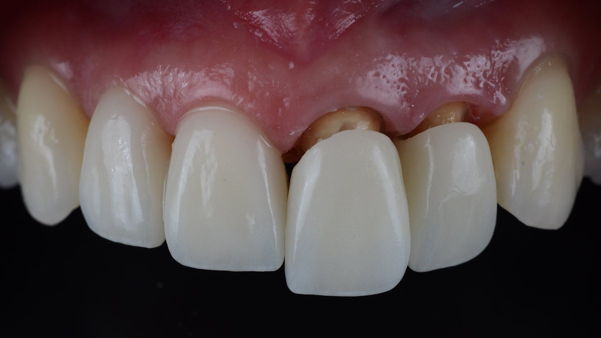 Close-up view of zirconium crowns placed on upper front teeth in Turkey