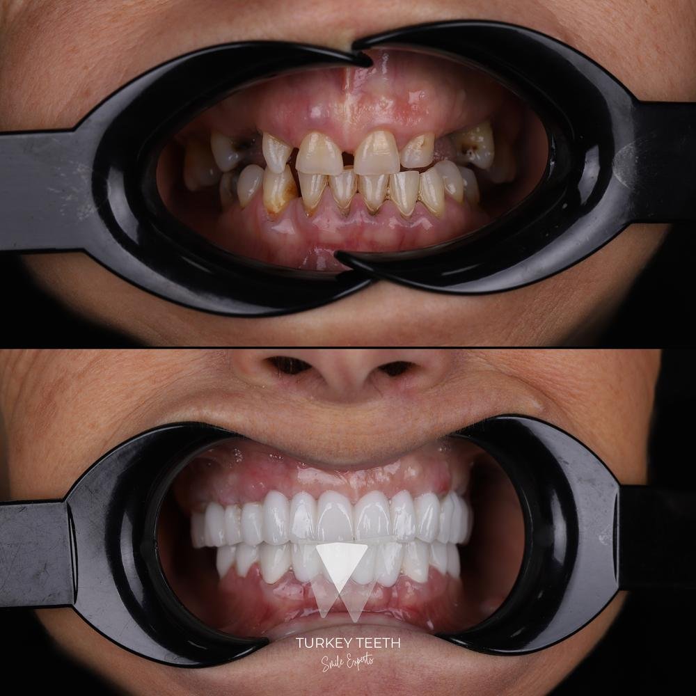 Before and after photos of full arch All-on-4 implant treatment