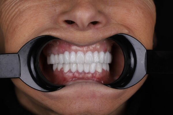 Final smile after All-on-4 dental implant treatment in Turkey