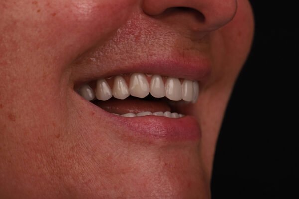 Final side view of smile after All-on-4 implants in Turkey