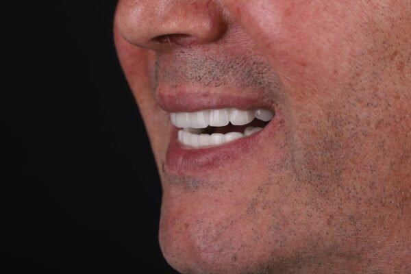 Final smile after All-on-6 dental implants in fully edentulous case