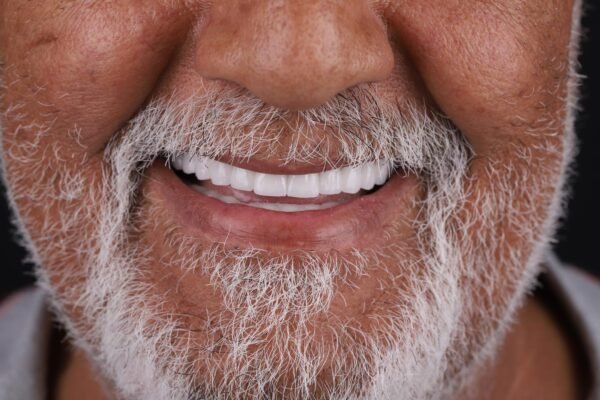 Final smile after All-on-6 full mouth dental implants in Turkey