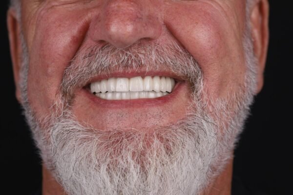 Smile result after All-on-6 fixed prosthetic treatment in Turkey
