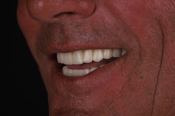 Final smile result after All-on-6 and zirconia restoration in Turkey