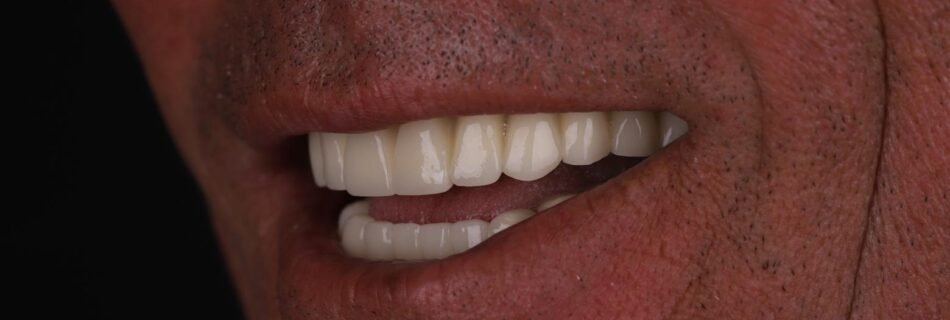 Final smile result after All-on-6 and zirconia restoration in Turkey
