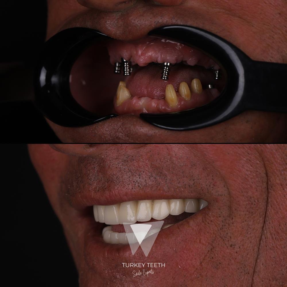 Before and after image showing full mouth restoration with All-on-6 implants and zirconia crowns