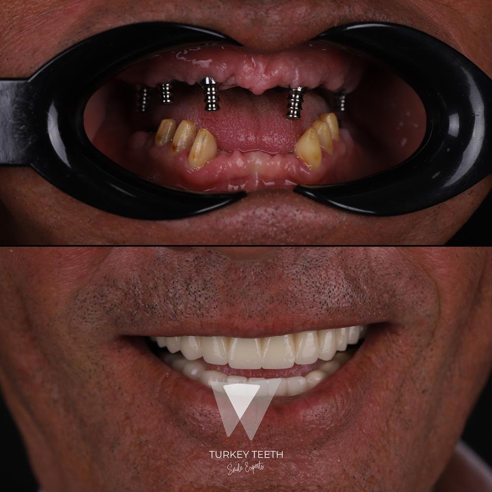 Side profile of All-on-6 and zirconia full mouth restoration in Turkey
