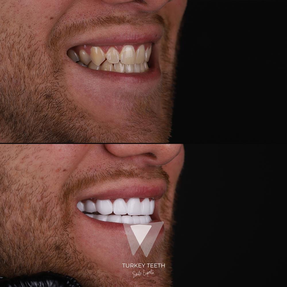 Before and after images of Hollywood Smile treatment for uneven teeth in Turkey