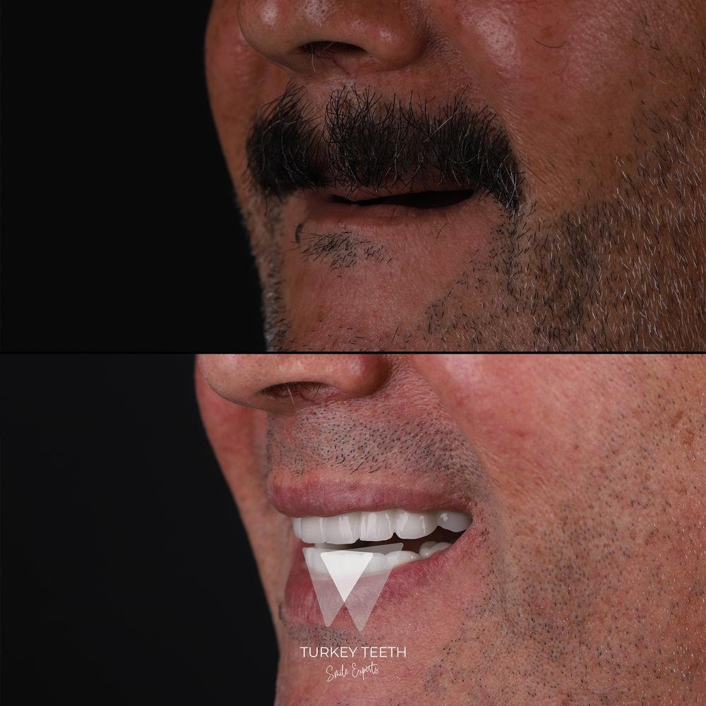 Side profile before and after All-on-6 implant restoration