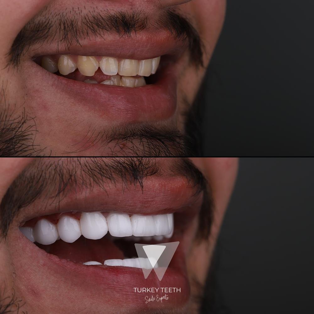 Before and after side profile of Hollywood Smile treatment in Turkey for male patient