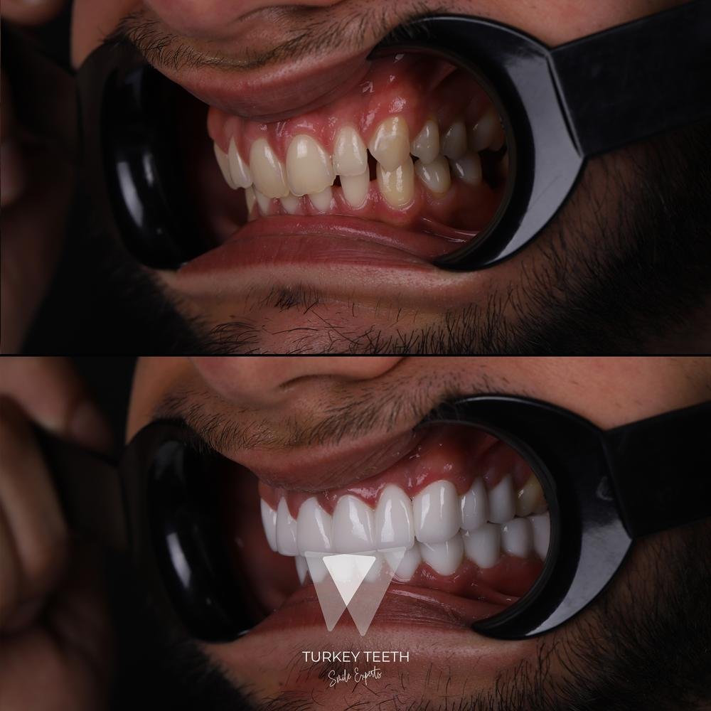 This photo captures the final aesthetic result of a Hollywood Smile makeover using high-quality laminate veneers at Turkey Teeth.