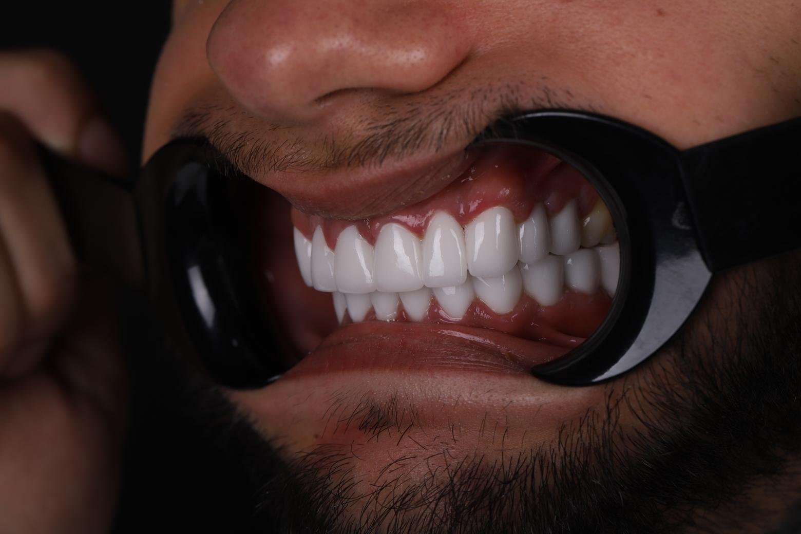 Final result of Hollywood Smile with laminate veneers in Turkey