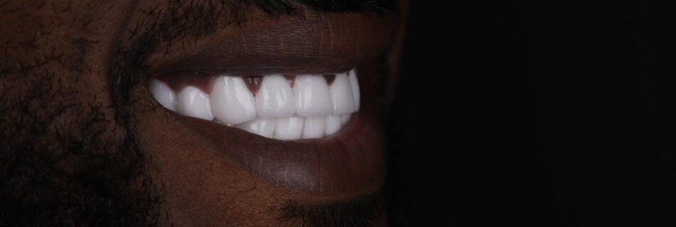 Final smile result after Hollywood Smile treatment for severe discoloration