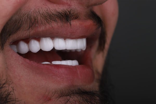 Side profile of Hollywood Smile result after cosmetic dental treatment in Turkey