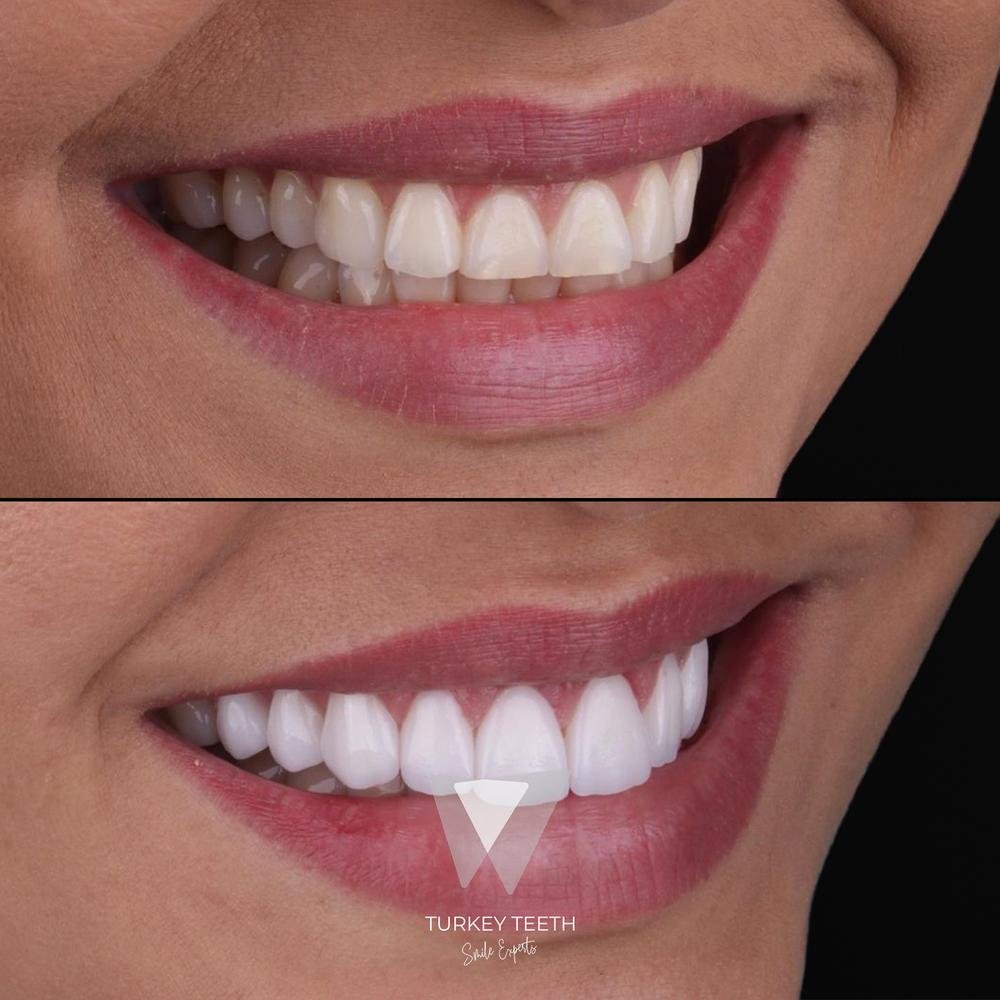 Before and after comparison of a smile makeover with laminate veneers