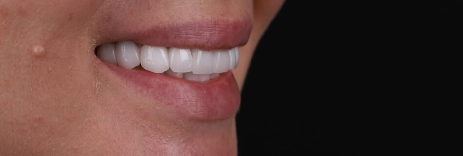 Final result after smile design correcting discoloration in Turkey