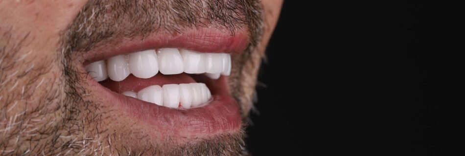 Final smile result after makeover for discolored teeth in Turkey – side profile