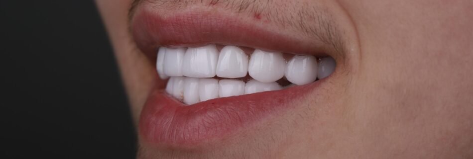 Final side view result after smile makeover for enamel defect correction