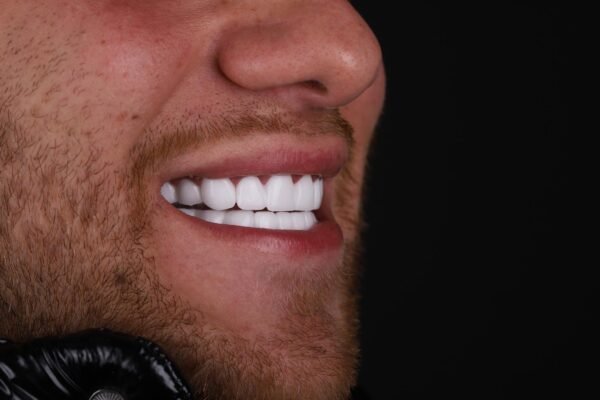 Hollywood Smile result for uneven teeth correction in Turkey – side profile