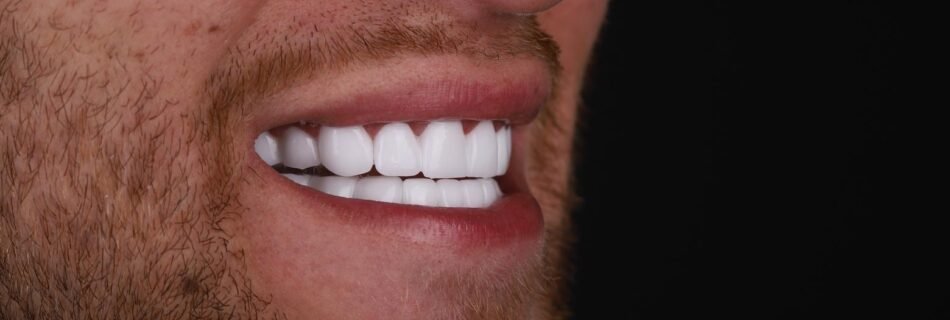 Hollywood Smile result for uneven teeth correction in Turkey – side profile