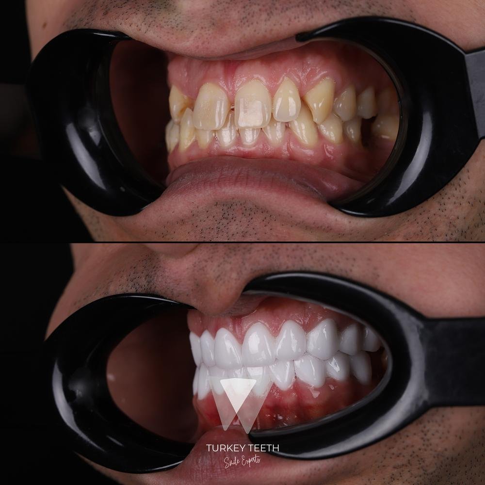 Before and after right view of veneer smile makeover in Turkey