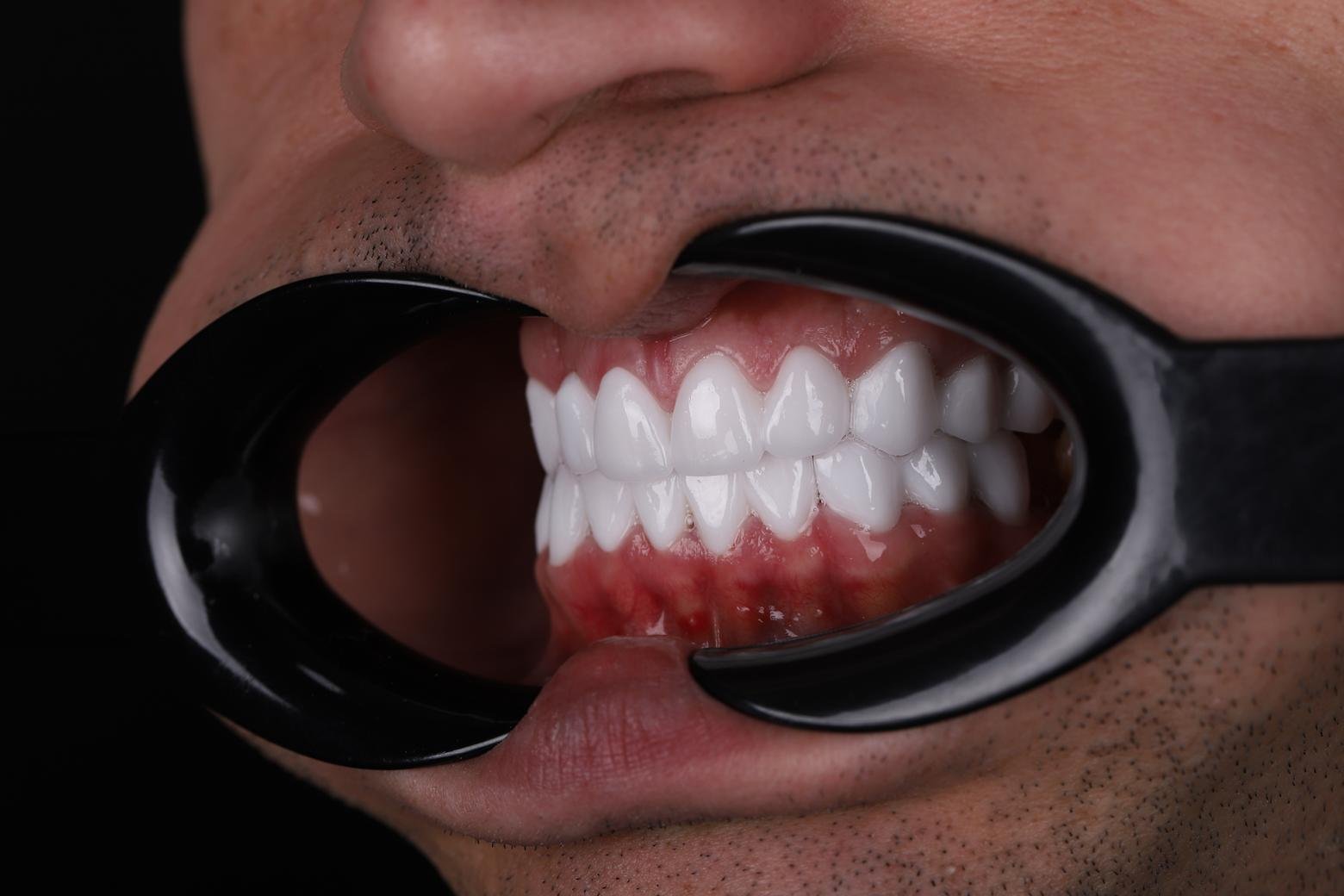Right side smile result after veneer treatment in Turkey