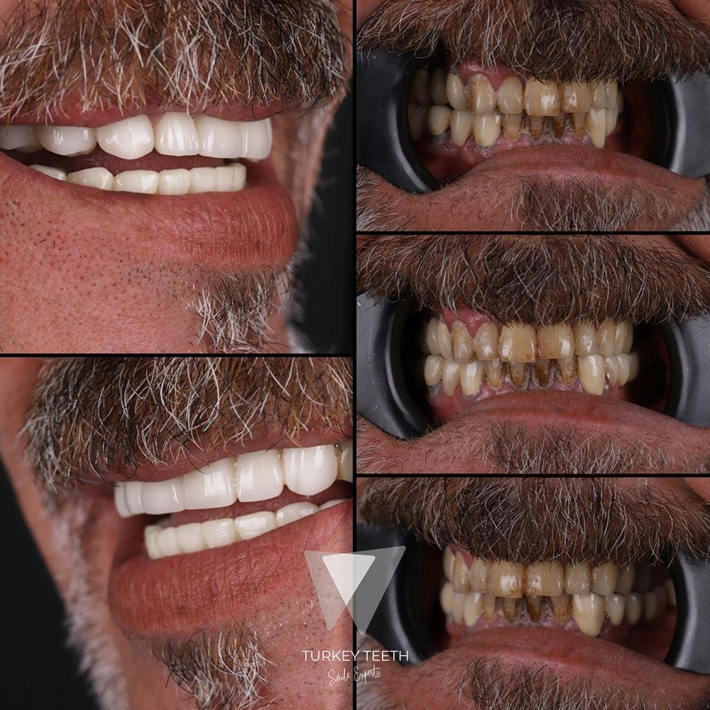 Before and after images of zirconium crowns full mouth treatment in Turkey