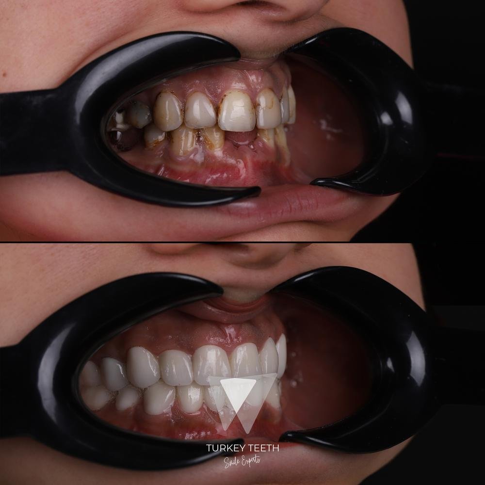 Before and after zirconium crown restoration in Turkey