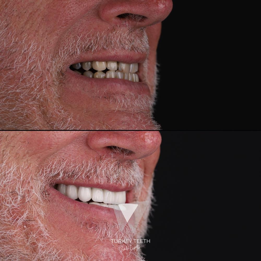 Before and after comparison of zirconium crowns treatment in an older male patient