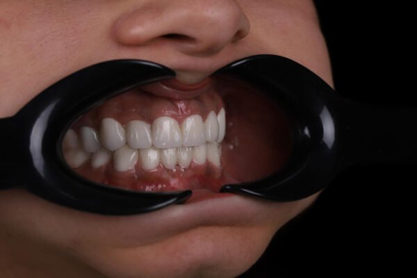 Final smile after zirconium crown smile makeover in Turkey