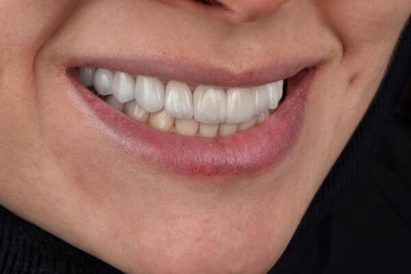 Final smile result after zirconium crowns full smile makeover for female patient