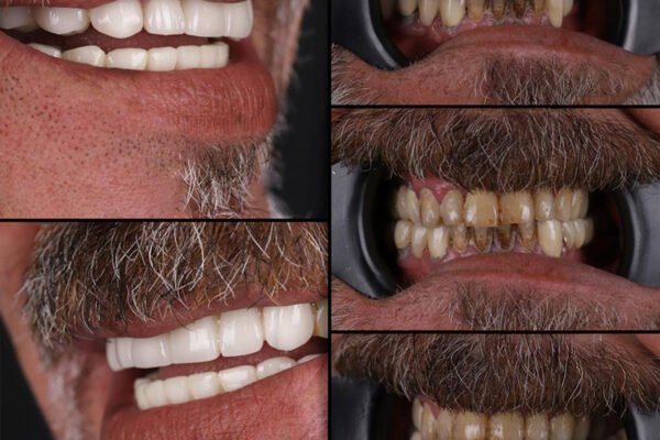 Final smile result after full mouth zirconium crown treatment for male patient