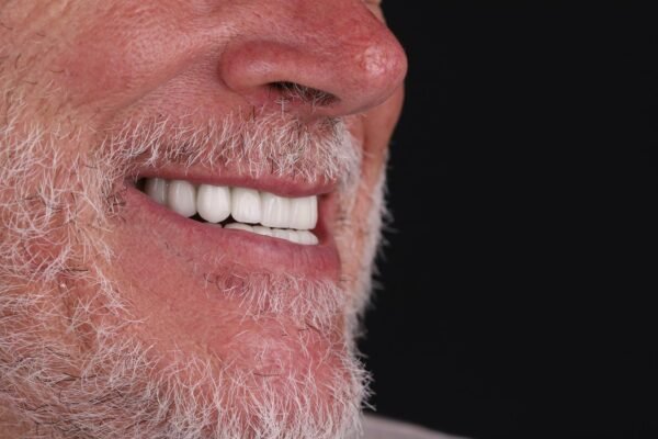 Final smile result of senior male patient after zirconium crown treatment